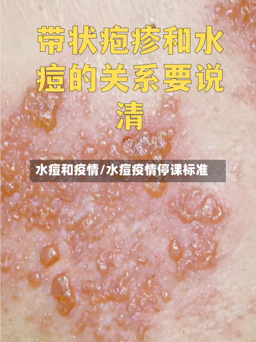 水痘和疫情/水痘疫情停课标准